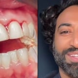 Dentist Shares How To Start Curing Your Gingivitis At Home Today