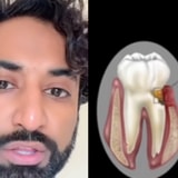Dentist Explains How Gum Disease Can Be Linked To Colon Cancer